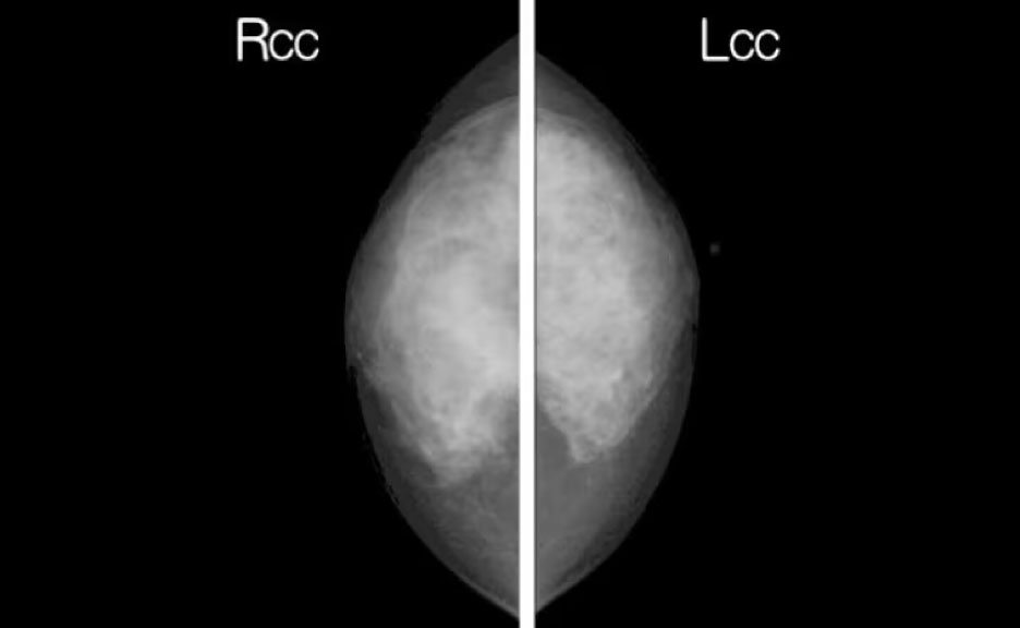写真）上：従来のX線マンモグラフィの測定画像