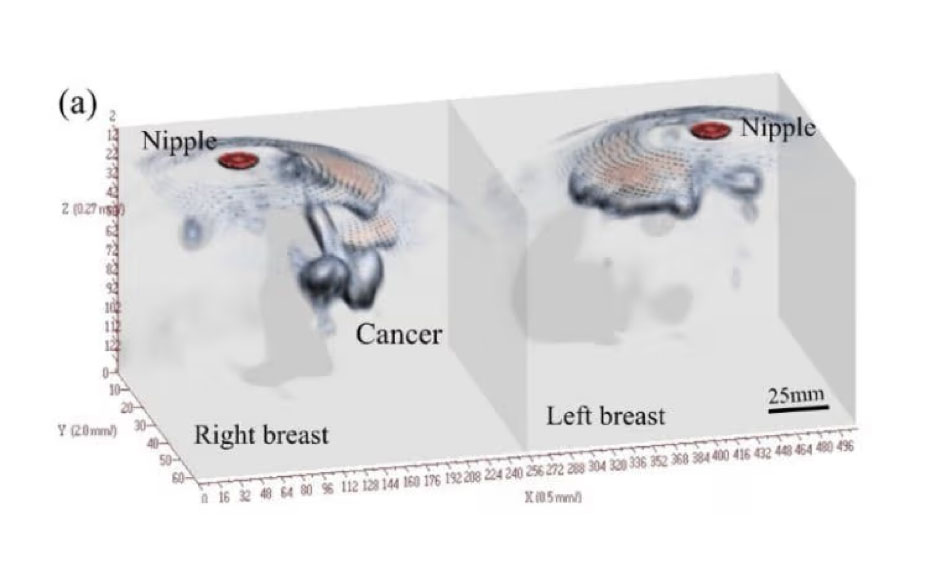 写真）下：IGSマイクロ波マンモグラフィの測定結果の画像